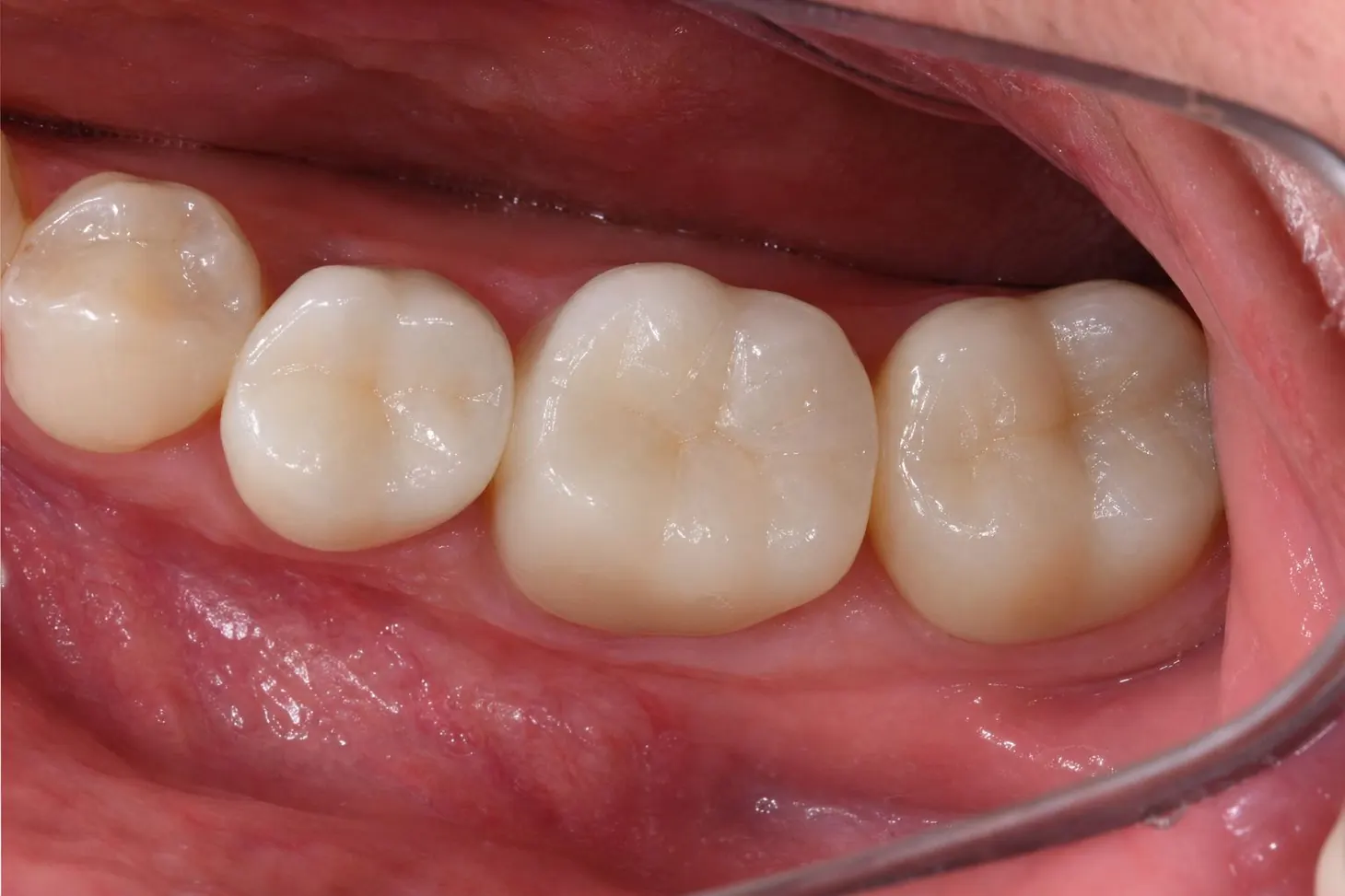 Functional Restoration — after treatment